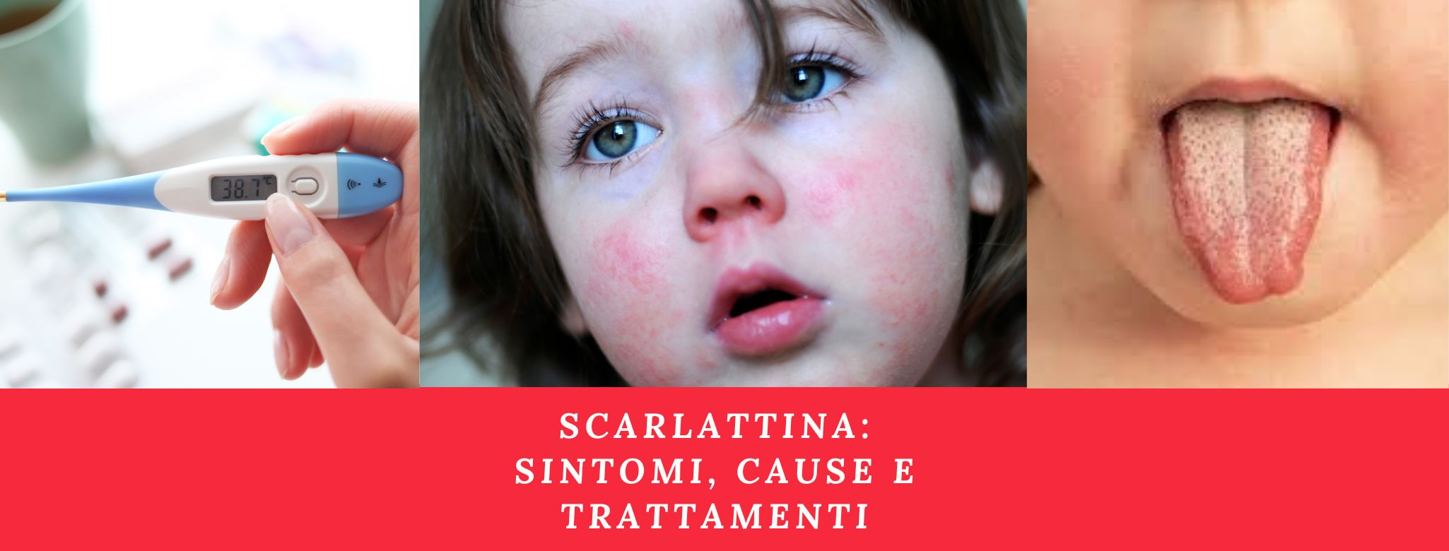 Scarlattina: Sintomi, Cause E Trattamenti - Emporio Della Salute